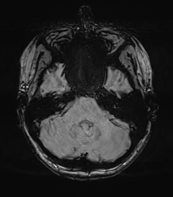 File:Cavernoma with bleed - midbrain (Radiopaedia 54546-60773 Axial SWI 13).png