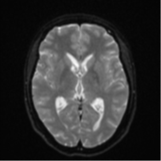 File:Cavernoma with bleed - midbrain (Radiopaedia 54546-60774 Axial DWI 13).png