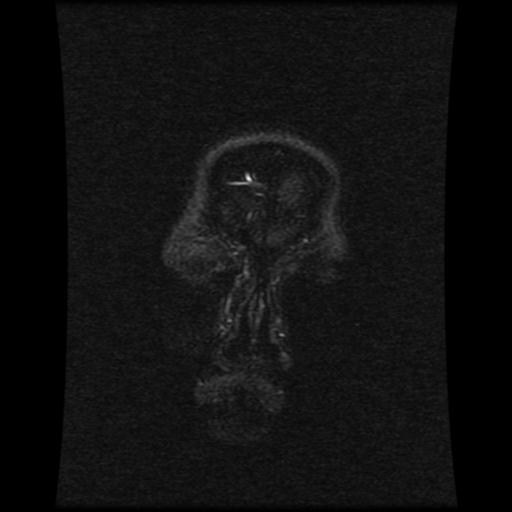Cavernoma with developmental venous anomaly (Radiopaedia 22470-22507 MRV 120).jpg