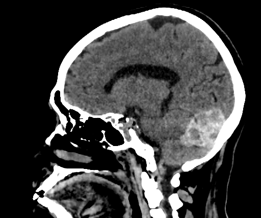 Cavernous hemangioma of the cerebellar falx (Radiopaedia 73025-83723 B 140).jpg