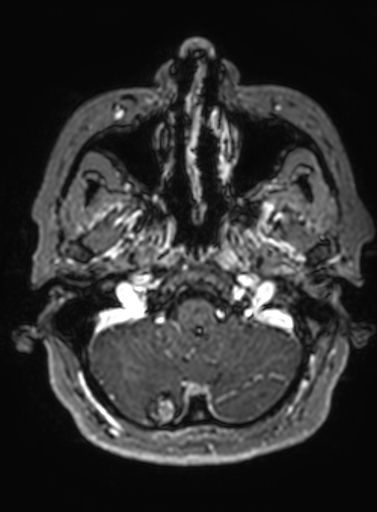 File:Cavernous hemangioma of the cerebellar falx (Radiopaedia 73025-83724 Axial T1 C+ 289).jpg