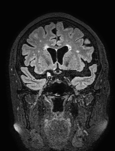 Cavernous hemangioma of the cerebellar falx (Radiopaedia 73025-83724 Coronal FLAIR 131).jpg