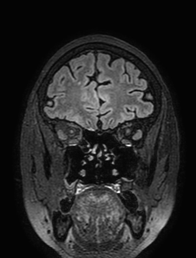 Cavernous hemangioma of the cerebellar falx (Radiopaedia 73025-83724 Coronal FLAIR 71).jpg