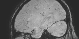 Cavernous hemangioma of the cerebellar falx (Radiopaedia 73025-83724 Sagittal BOLD 150).jpg