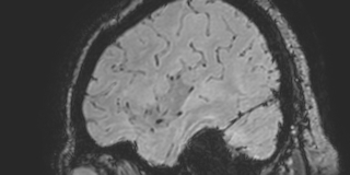 Cavernous hemangioma of the cerebellar falx (Radiopaedia 73025-83724 Sagittal BOLD 36).jpg