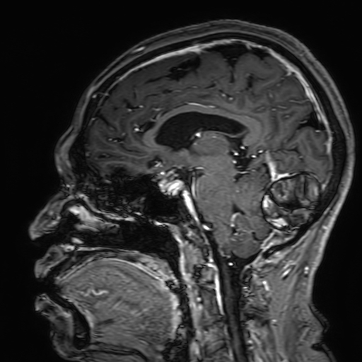 Cavernous hemangioma of the cerebellar falx (Radiopaedia 73025-83724 Sagittal T1 C+ 114).jpg