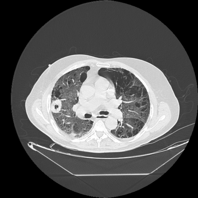 Cavitating bronchogenic carcinoma (Radiopaedia 44489-48162 Axial lung window 37).jpg
