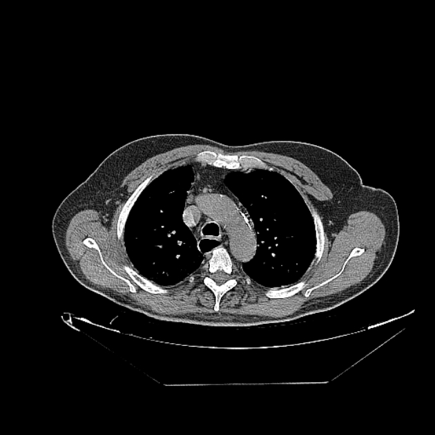 Cavitating bronchogenic carcinoma (Radiopaedia 44489-48162 Axial non-contrast 20).jpg