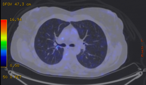 File:Cavitating lung mass - squamous cell carcinoma (Radiopaedia 48047-52853 A 41).png