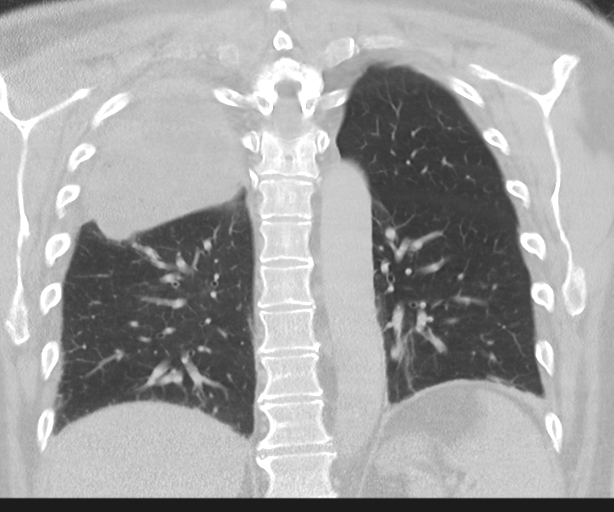 Cavitating pneumonia (Radiopaedia 45998-50329 Coronal lung window 35).png