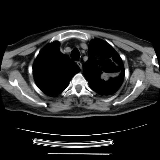 Cavitating pulmonary metastases (Radiopaedia 89545-106544 Axial non-contrast 11).jpg