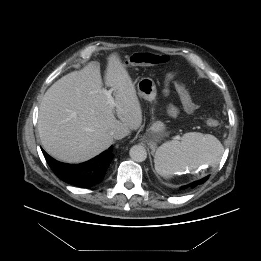 Cecal adenocarcinoma (Radiopaedia 64871-73817 A 14).jpg
