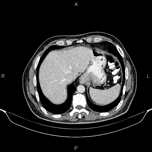 Cecal adenocarcinoma (Radiopaedia 85324-100916 B 12).jpg
