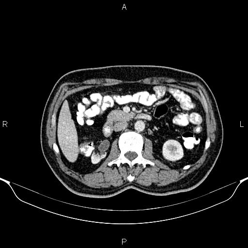 Cecal adenocarcinoma (Radiopaedia 85324-100916 B 40).jpg