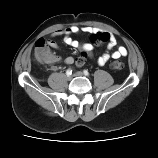Cecal mass causing appendicitis (Radiopaedia 59207-66531 A 59).jpg
