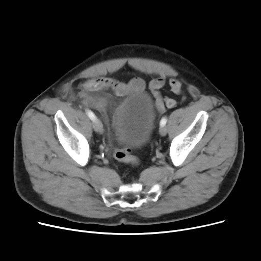 Cecal mass causing appendicitis (Radiopaedia 59207-66531 A 74).jpg
