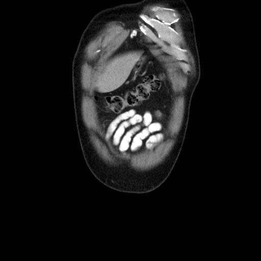 Cecal mass causing appendicitis (Radiopaedia 59207-66531 B 4).jpg