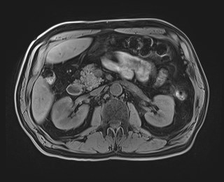 Cecal mass causing appendicitis (Radiopaedia 59207-66532 Axial T1 55).jpg