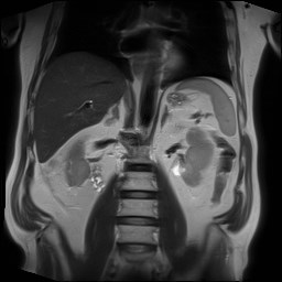 File:Cecal mass causing appendicitis (Radiopaedia 59207-66532 Coronal T2 22).jpg