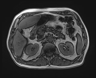 Cecal mass causing appendicitis (Radiopaedia 59207-66532 D 49).jpg