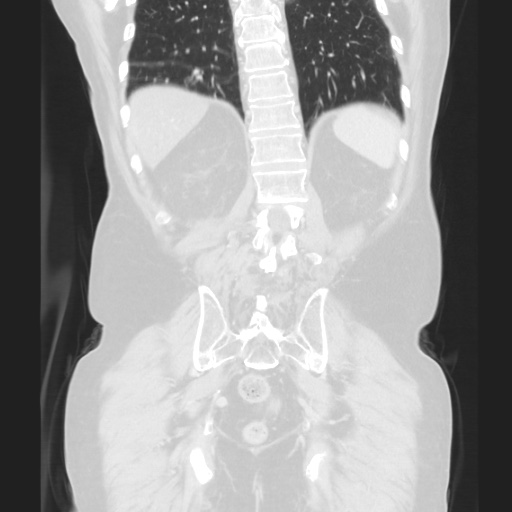 Cecal volvulus (Radiopaedia 75378-86620 Coronal lung window 107).jpg