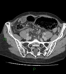 Cecal volvulus (Radiopaedia 86741-102900 A 96).jpg