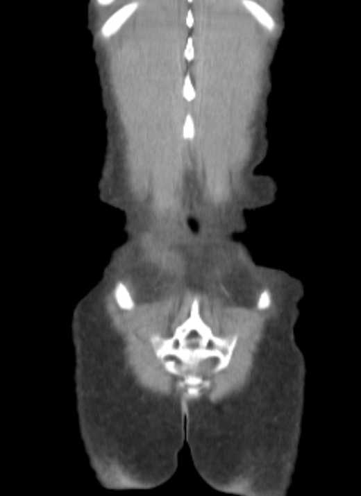 Cecal volvulus with pneumatosis coli (Radiopaedia 68572-78178 B 3).jpg