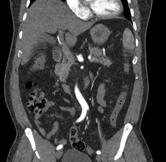 Celiac artery dissection (Radiopaedia 52194-58080 C 42).jpg