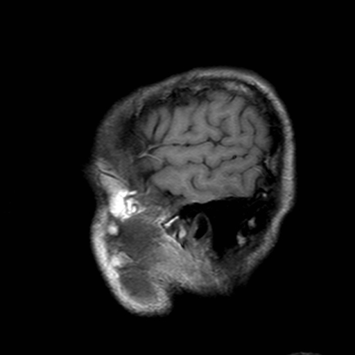 File:Central-variant posterior reversible encephalopathy syndrome (PRES) (Radiopaedia 43880-47359 Sagittal T1 1).jpg
