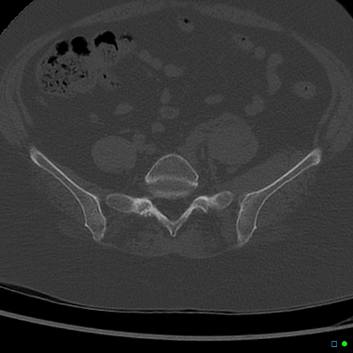 Central fracture-dislocation of the acetabulum (Radiopaedia 36578-38150 Axial bone window 5).jpg