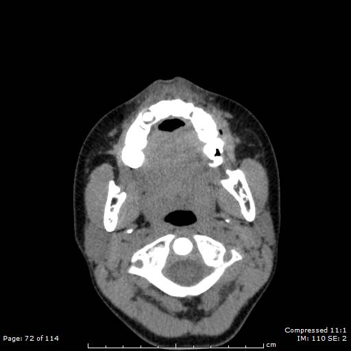 File:Central giant cell granuloma (Radiopaedia 45612-49754 Axial 71).jpg