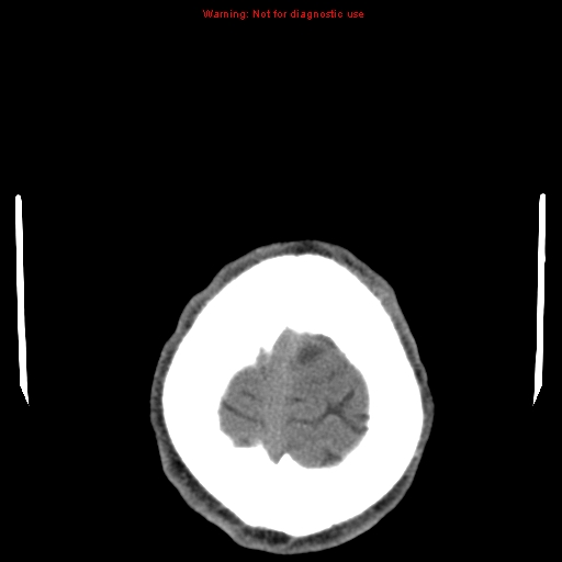 File:Central nervous system vasculitis (Radiopaedia 8410-9234 Axial non-contrast 26).jpg