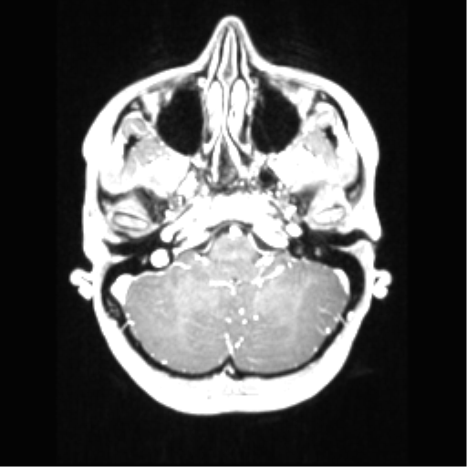 Central neurocytoma (Radiopaedia 37664-39557 Axial T1 C+ 18).png