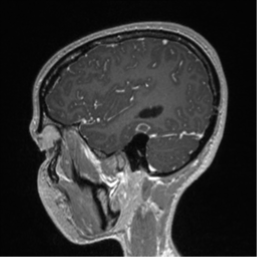 Central neurocytoma (Radiopaedia 37664-39557 Sagittal T1 C+ 24).png