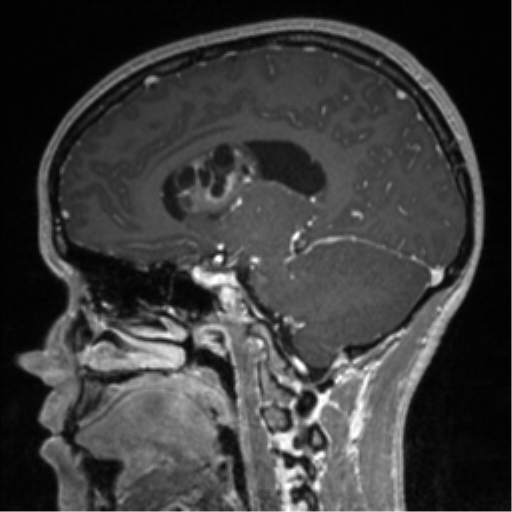File:Central neurocytoma (Radiopaedia 37664-39557 Sagittal T1 C+ 56).png