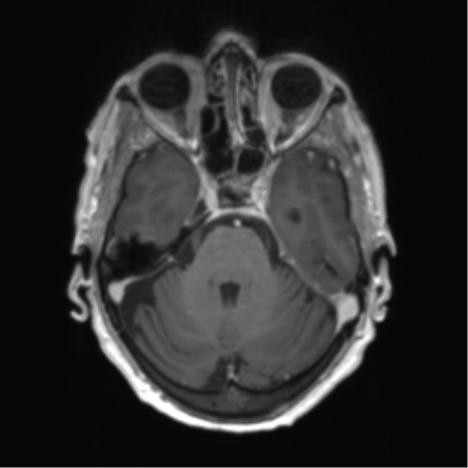 Central neurocytoma (Radiopaedia 65317-74345 Axial T1 C+ 12).png
