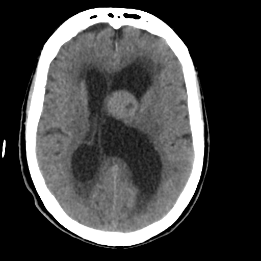 Central neurocytoma (Radiopaedia 65317-74346 Axial non-contrast 28).png