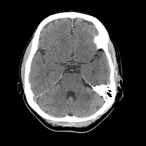 Central neurocytoma (Radiopaedia 68725-78432 Axial non-contrast 16).jpg