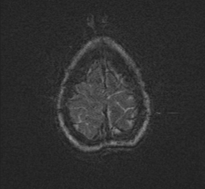 Central neurocytoma (Radiopaedia 70263-80336 Axial SWI 56).jpg