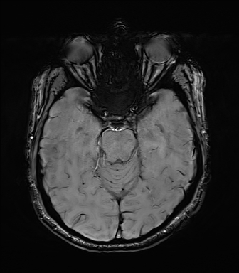 File:Central neurocytoma (Radiopaedia 71068-81303 Axial SWI 20).jpg