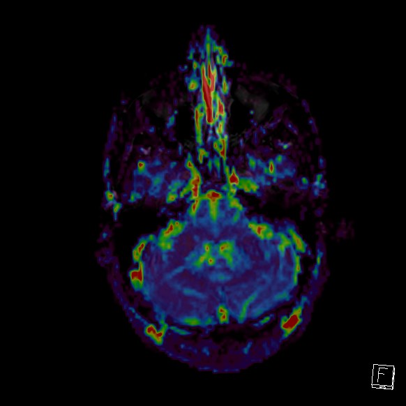 Central neurocytoma (Radiopaedia 84497-99872 Axial Perfusion 255).jpg