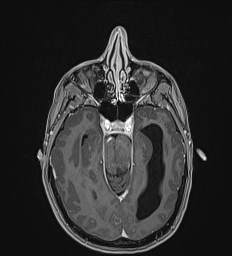Central neurocytoma (Radiopaedia 84497-99872 Axial T1 C+ 57).jpg