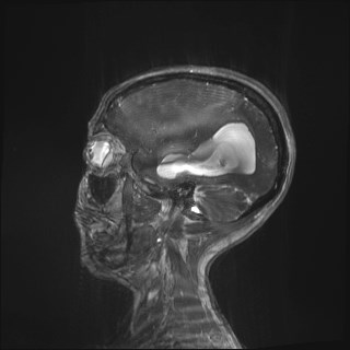 File:Central neurocytoma (Radiopaedia 84497-99872 Sagittal CISS 86).jpg