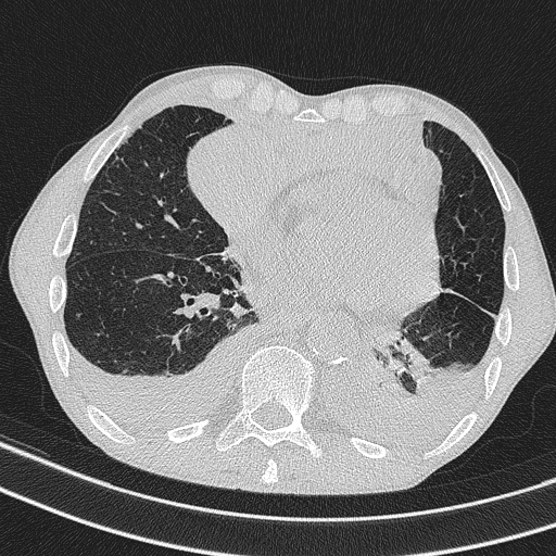 Central venous catheter tip extravasation (Radiopaedia 82828-97113 Axial lung window 57).jpg