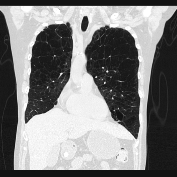 Centrilobular pulmonary emphysema (Radiopaedia 24495-24789 Coronal lung window 23).jpg