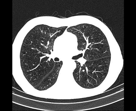 Centrilobular pulmonary emphysema (Radiopaedia 62468-70718 Axial lung window 35).jpg