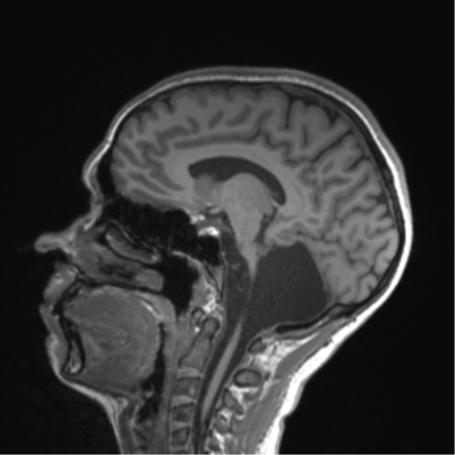 Cerebellar agenesis with hypoplastic pons (pontocerebellar hypoplasia) (Radiopaedia 57224-64138 Sagittal T1 33).png