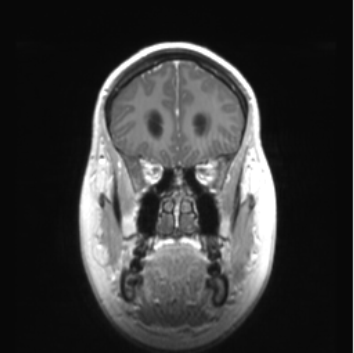 Cerebellar ependymoma complicated by post-operative subdural hematoma (Radiopaedia 83322-97736 Coronal T1 C+ 14).png