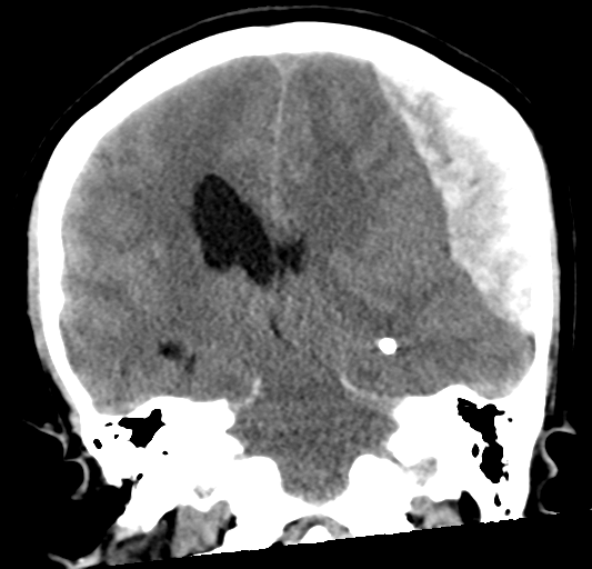 File:Cerebellar ependymoma complicated by post-operative subdural hematoma (Radiopaedia 83322-97737 Coronal non-contrast 22).png