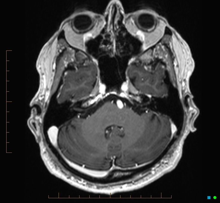 Cerebellar gangliocytoma (Radiopaedia 65377-74422 Axial T1 C+ 26).jpg